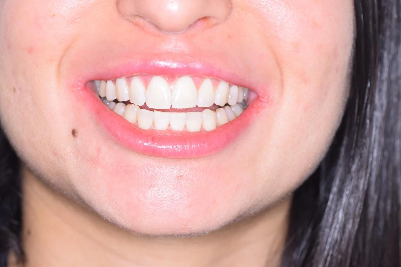 Fotografia del sorriso che comprende labbra, denti anteriori e parte inferiore del viso.